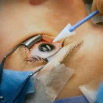 مراقبت های عمل لیزیک چشم