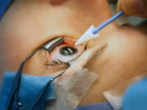 مراقبت های عمل لیزیک چشم