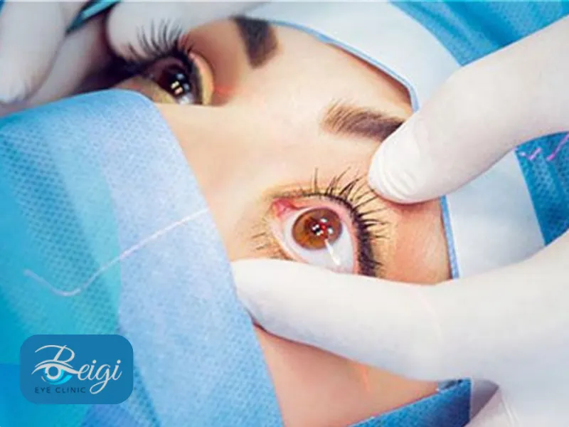 عمل لیزیک یکی از عمل‌های چشم برای حذف عینک است.
