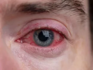 ضعیف شدن چشم بعد از عمل